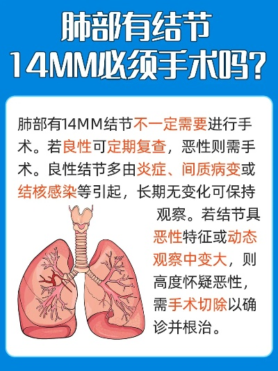 肺4cm结节的病情分析及治疗建议