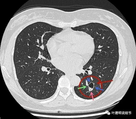 肺4cm结节的病情分析及治疗建议-第2张图片-www.211178.com_果博福布斯