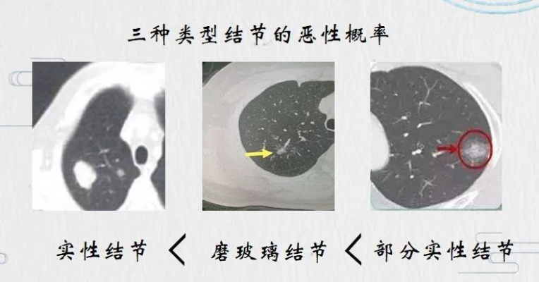 肺4cm结节的病情分析及治疗建议-第3张图片-www.211178.com_果博福布斯